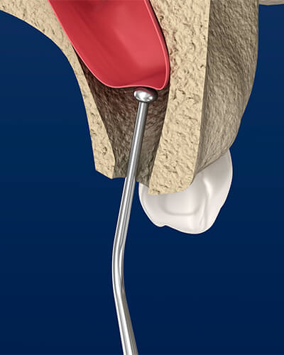 A 3D graphic showing a dental instrument being used for bone grafting which is a process sometimes used when placing dental implants.