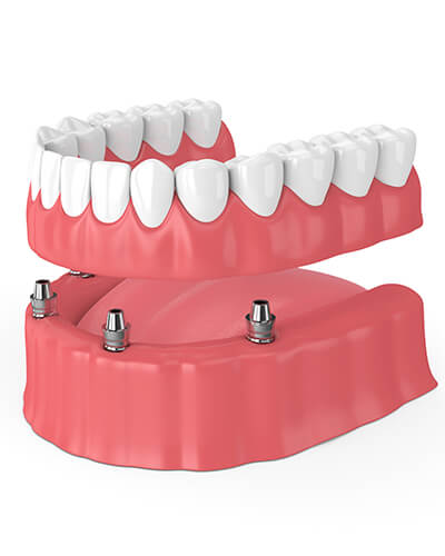 A 3D illustration of Implant-Retained Dentures.