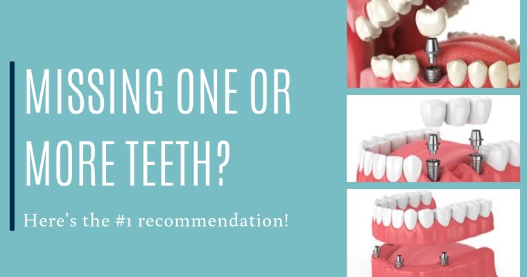 3 Types of Dental Implants (Which One Is Best for You?)