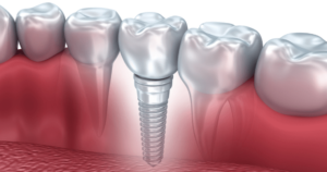 Image showing a dental implant